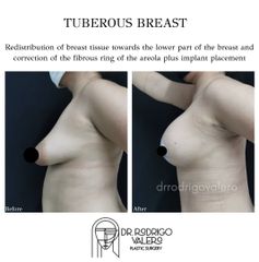 Mastopexia - Dr. Rodrigo Valero Jarillo