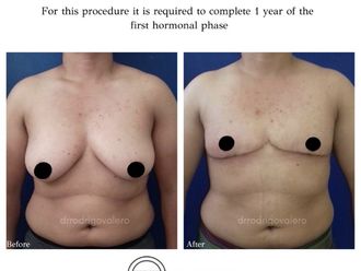 Reasignación de sexo antes y después - 828675