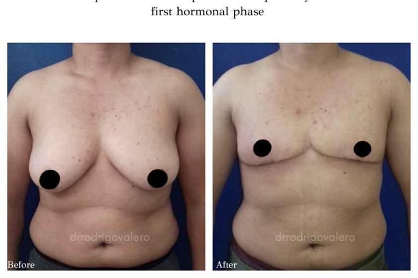 Reasignación de sexo antes y después - 828675
