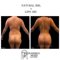 Liposucción - Dr. Rodrigo Valero Jarillo