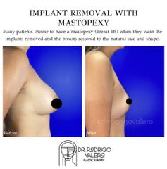 Extracción de implantes con Mastopexia -Dr Rodrigo Valero