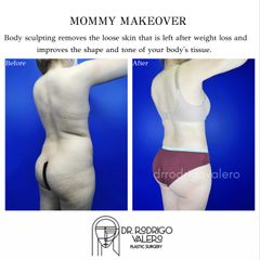 Mommy makeover - Dr. Rodrigo Valero Jarillo