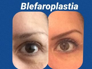  Antes y después de Blefaroplastia.