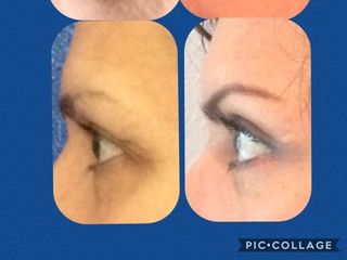 Antes y después de Blefaroplastia. Grandes cambios