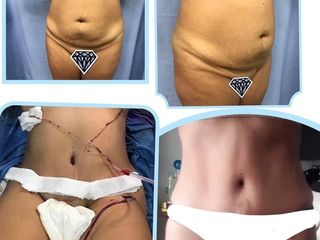 Antes y despés de Abdominoplastia 