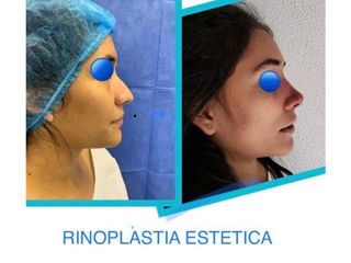 Antes y después de Rinoplastia