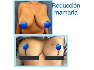 Antes y después de Reducción mamaria