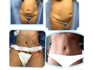 Antes y después de  Abdominoplastia