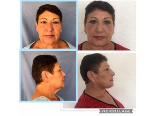 Antes y después de Rejuvenecimiento de cuello
