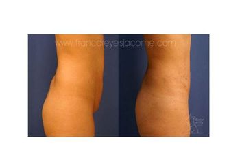 Antes y después de abdominoplastia