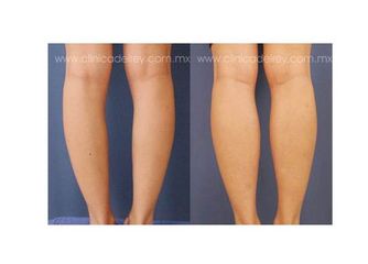 Antes y después Dr. Francisco F. Reyes Jacome 2