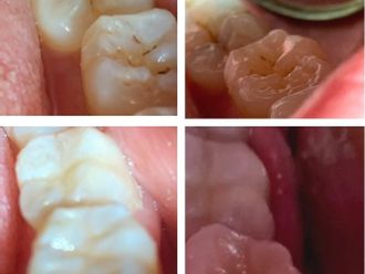 Blanqueamiento Dental - 820090
