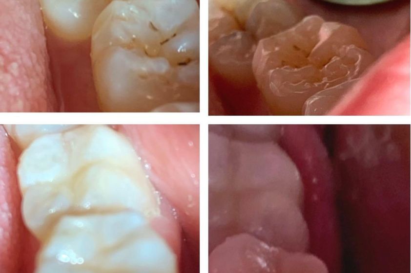 Blanqueamiento Dental antes y después - 820090
