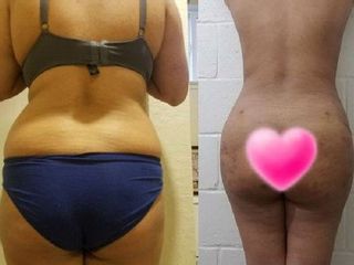 Antes y despues de  lipoescultura 360º con Brazilian Butt Lift