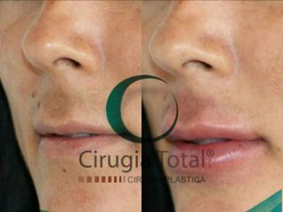 Antes y después de aumento de labios con acido hialuronico