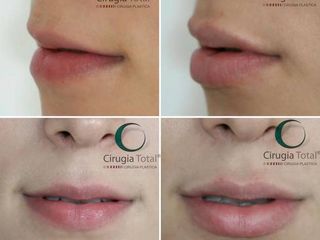 Antes y después de aumento de labios con acido hialuronico