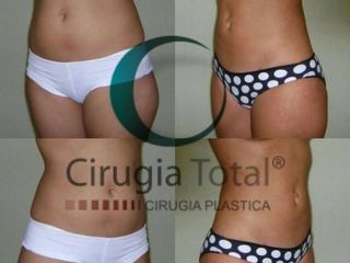 Antes y después de Lipoescultura 360º
