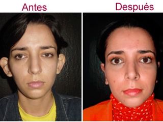 Antes y después de otoplastia