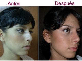 Antes y después de rinoplastia