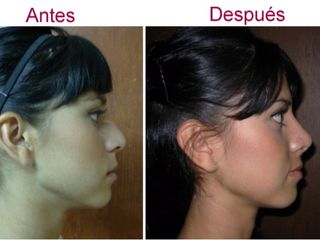 Antes y después de rinoplastia