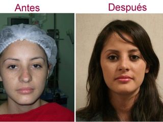 Antes y despues de rinoplastia