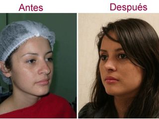 Antes y después de rinoplastia