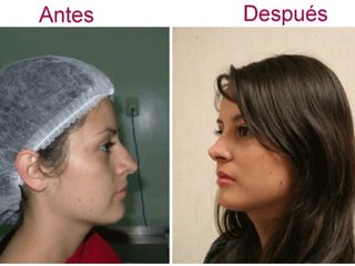 Antes y después de rinoplastia