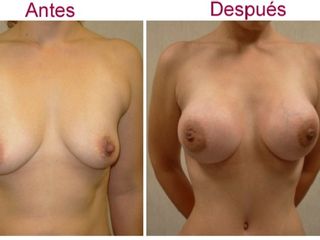 Antes y despues de aumento de senos