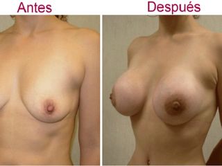 Antes y despues de aumento de senos