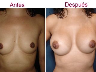 Antes y despues de aumento de senos