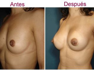 Antes y despues de aumento de senos