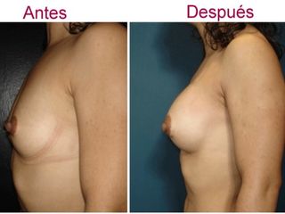 Antes y despues de aumento de senos