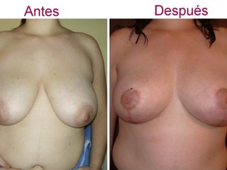 Antes y despues de reduccion del busto