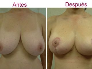 Antes y despues de elevacion del busto