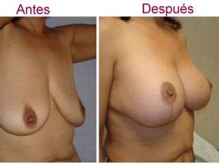 Antes y despues de elevacion del busto