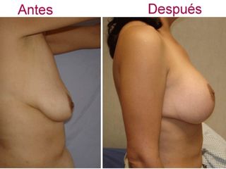 Antes y después de Aumento de busto
