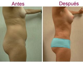 Antes y después de liposucción