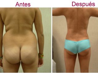 Antes y después de liposucción