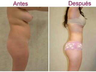 Antes y después de liposucción