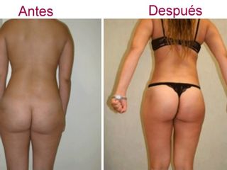 Antes y después de liposucción