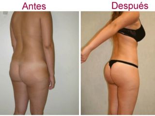 Antes y después de liposucción