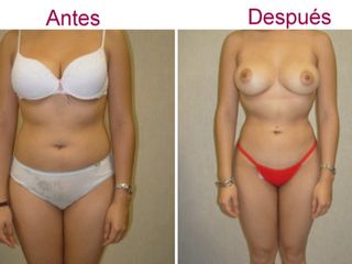 Antes y despues de liposuccion