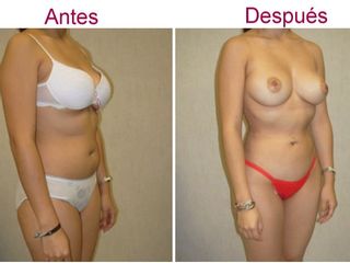 Antes y despues de liposuccion