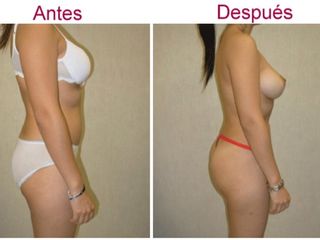 Antes y después de liposucción
