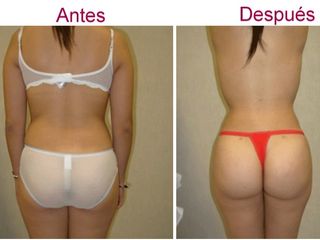 Antes y después de liposucción
