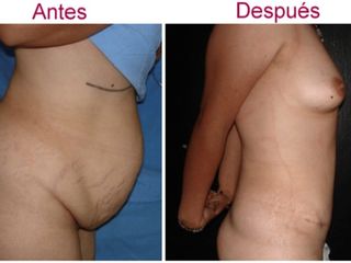 Antes y despues de abdominoplastia