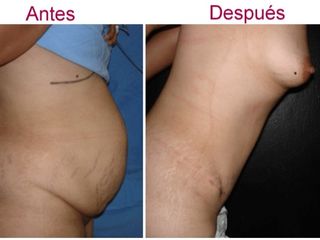 Antes y despues de abdominoplastia