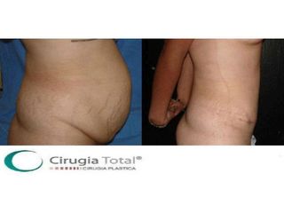 Antes y después de Abdominoplastia 