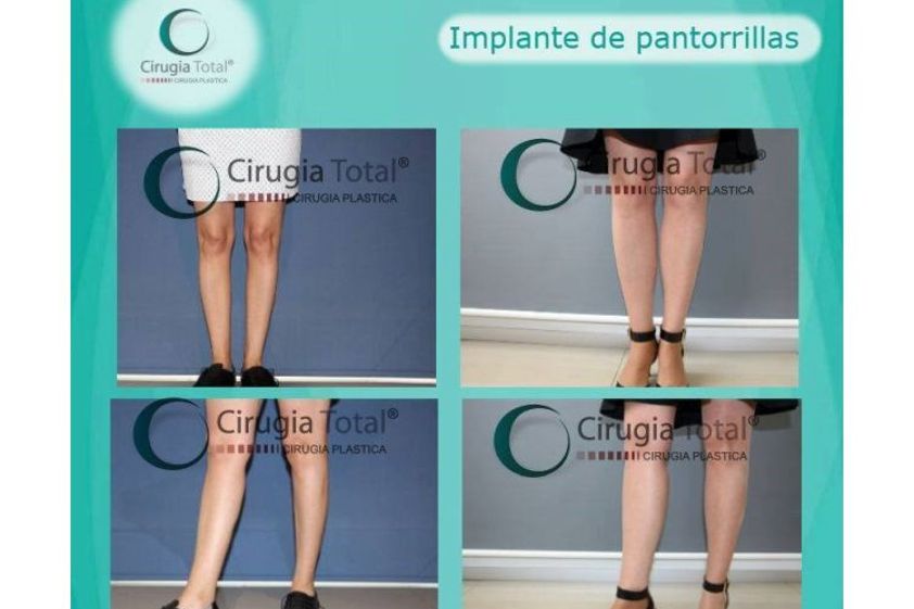 Aumento de pantorrillas antes y después - 701063
