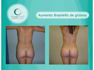 Antes y después de Gluteoplastia